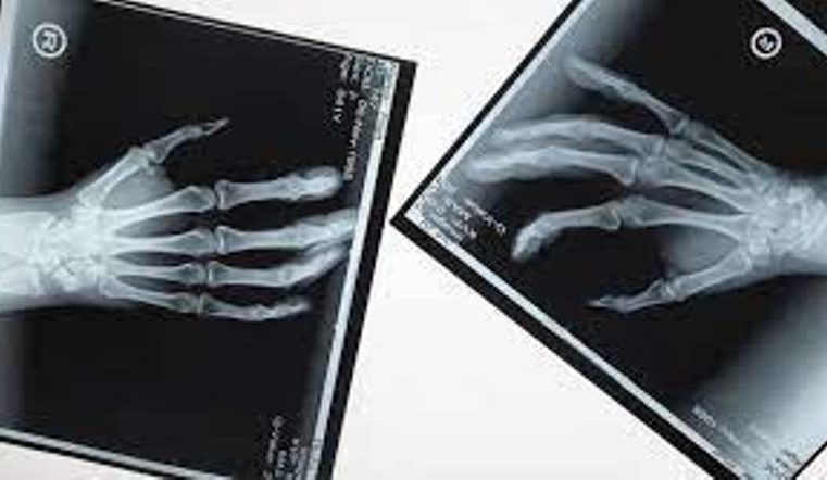 PF combate fraudes em sistema do SUS para recebimento de emendas parlamentares