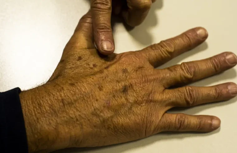 Câncer de pele gera R$ 4,6 mi em custos hospitalares em quase 2 anos