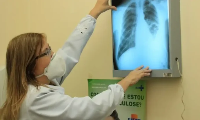 Dia Mundial de Combate à Tuberculose conscientiza sobre a prevenção
