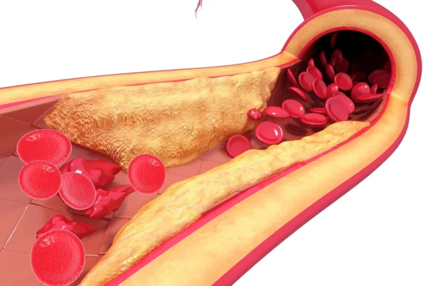 Cardiologista cita 5 hábitos simples que ajudam a “limpar” as artérias